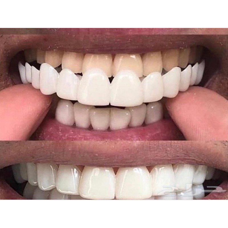 Mềm Dẻo Silicone Gel Nha Khoa  - đánh giá và giá Teeth Whitening Moulds