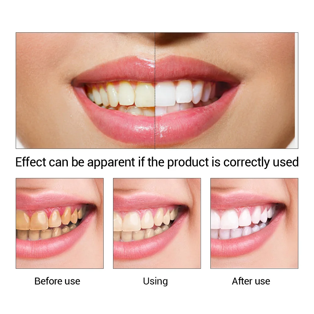 FTEENPLY Làm Trắng Răng Tinh C - đánh giá và giá Teeth Whitening Near Me
