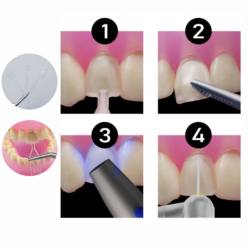 32pcs/Set Composite Resin Mold - đánh giá và giá Teeth Whitening Moulds