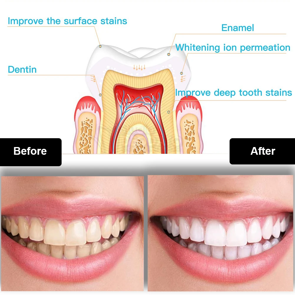 Dental Teeth Whitening Kit Min - đánh giá và giá Teeth Whitening Pens