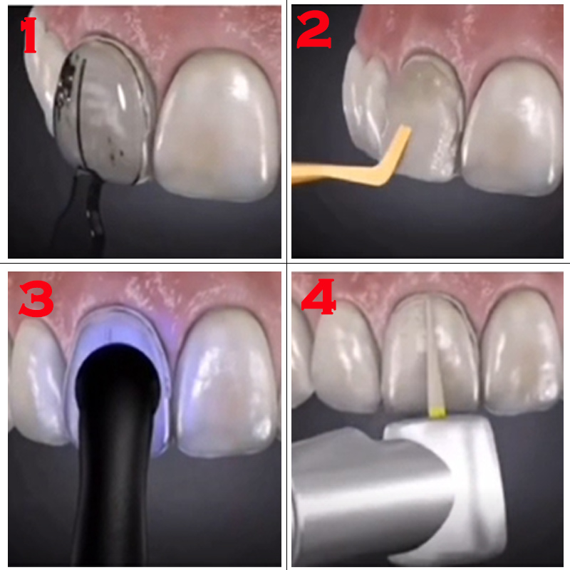 Autoclavable Dental Veneer Mou - đánh giá và giá Teeth Whitening Moulds