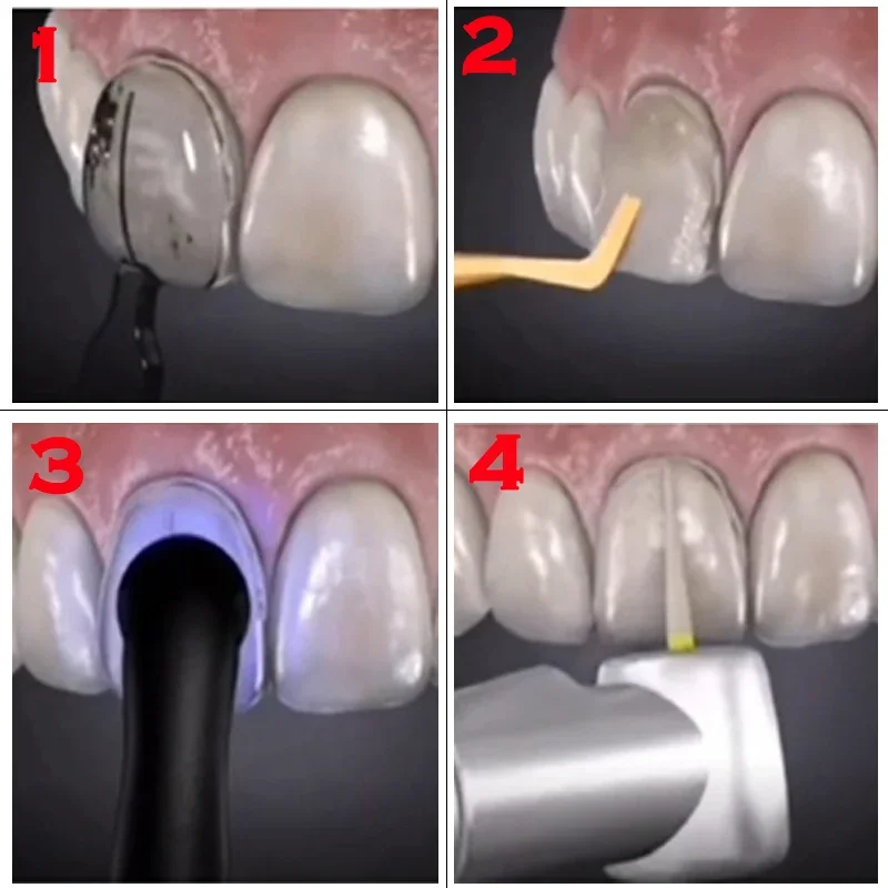 Dentals Mould For Composite Re - đánh giá và giá Teeth Whitening Moulds
