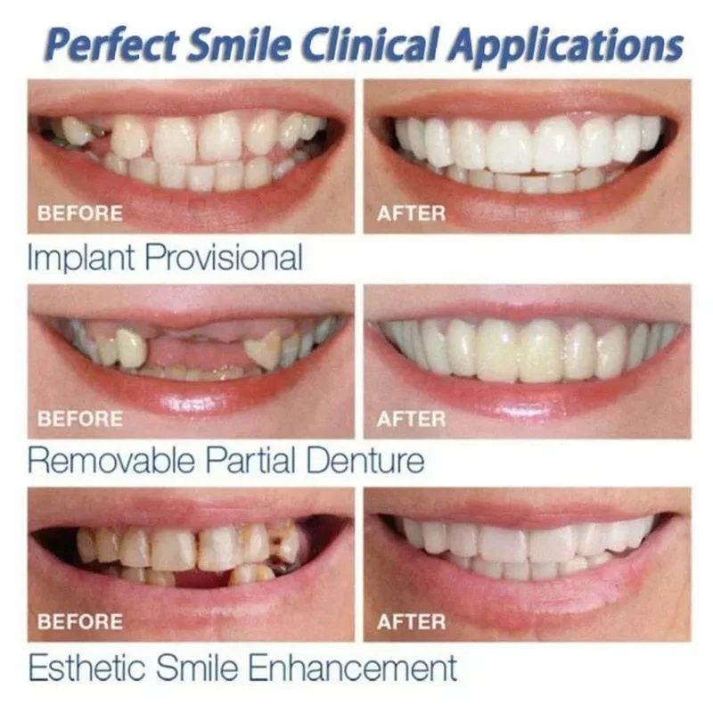 Snap-on Veneer Teeth Kit Adjus - đánh giá và giá Teeth Whitening Kit