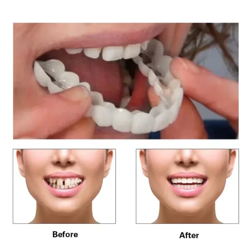 Snap-on Veneer Teeth Kit Adjus - đánh giá và giá Teeth Whitening Kit
